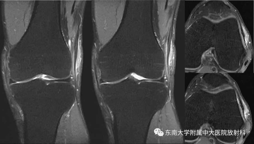 【PPT】髂胫束相关损伤-2