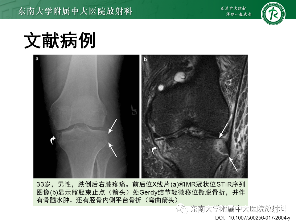 【PPT】髂胫束相关损伤-46