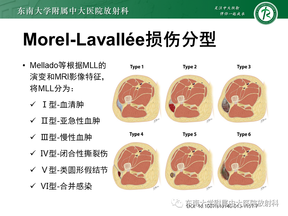 【PPT】髂胫束相关损伤-20