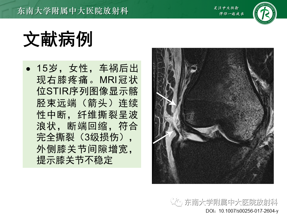 【PPT】髂胫束相关损伤-43