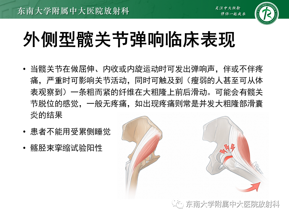 【PPT】髂胫束相关损伤-32