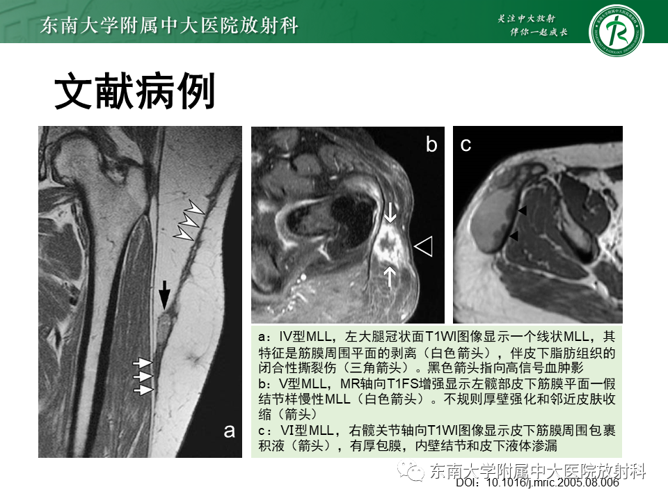 【PPT】髂胫束相关损伤-27
