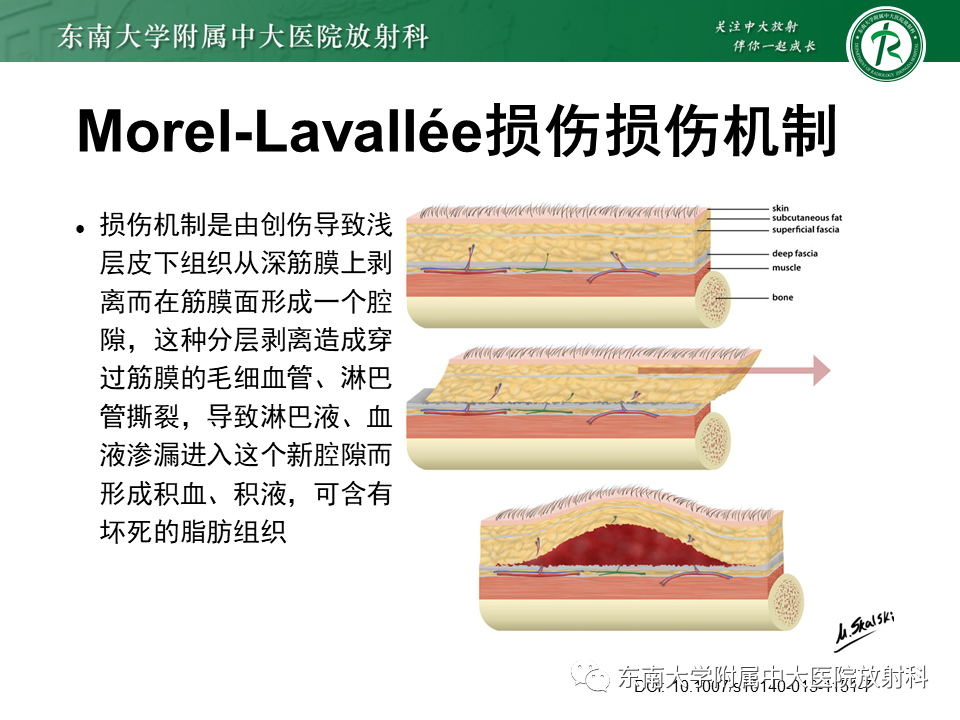 【PPT】髂胫束相关损伤-17