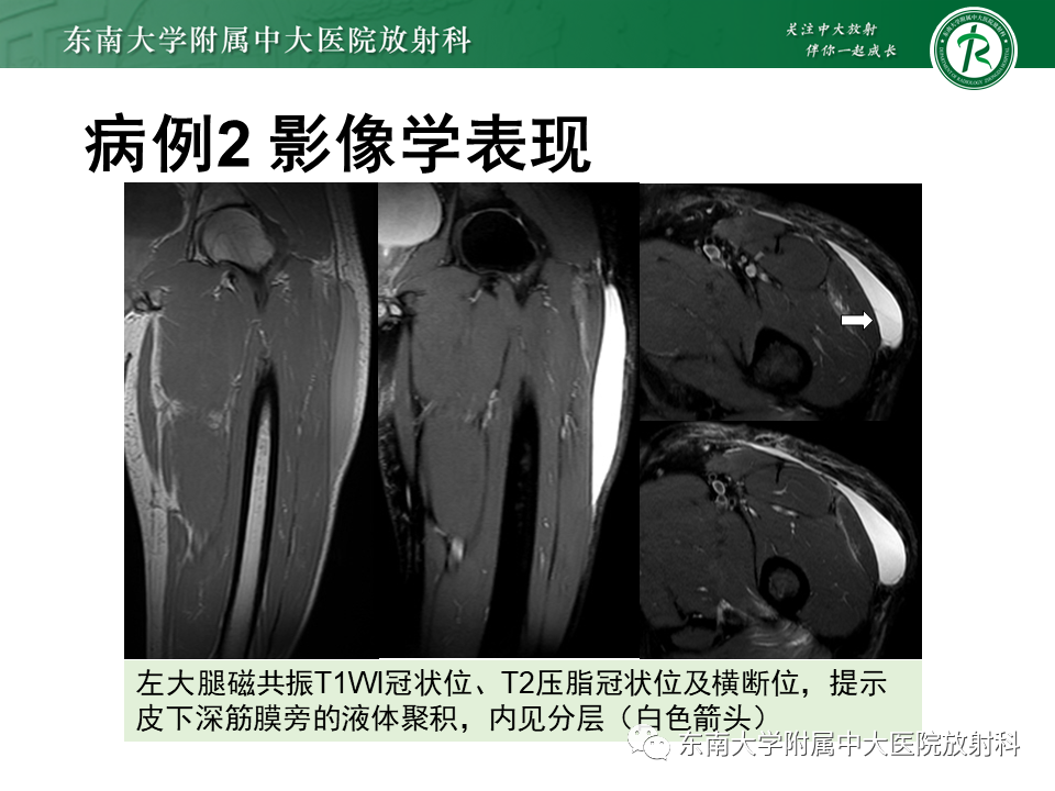 【PPT】髂胫束相关损伤-24