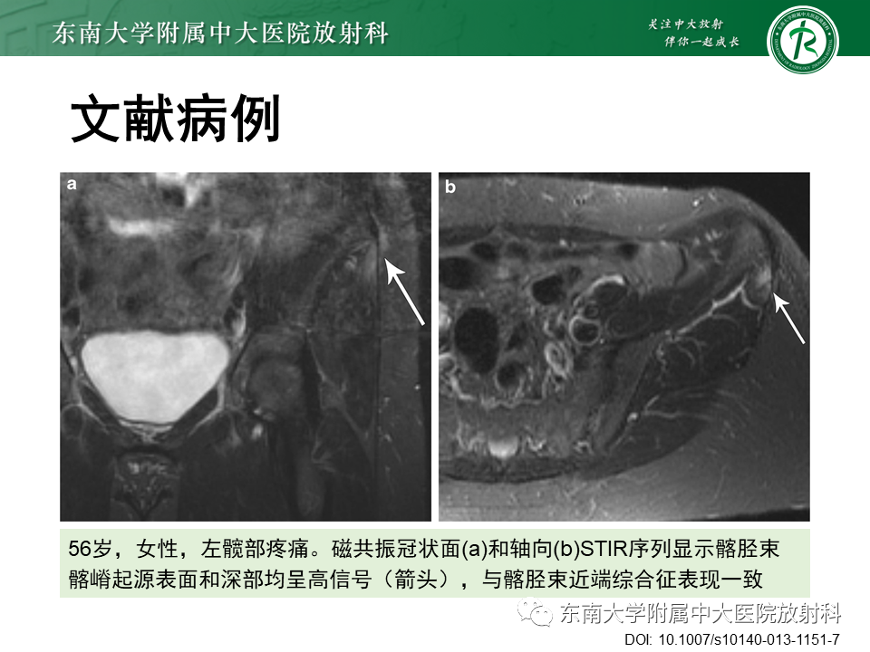 【PPT】髂胫束相关损伤-30