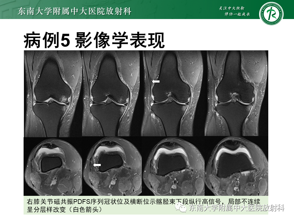 【PPT】髂胫束相关损伤-42