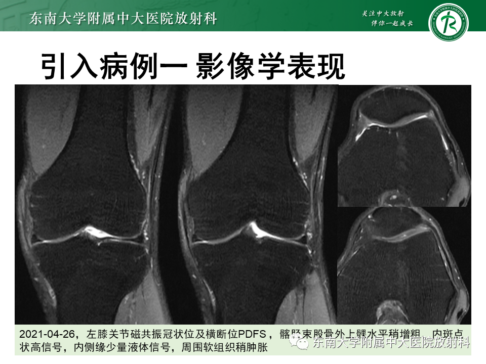 【PPT】髂胫束相关损伤-3