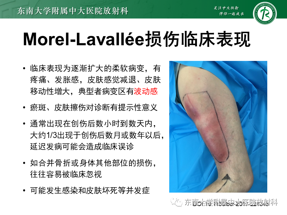 【PPT】髂胫束相关损伤-15