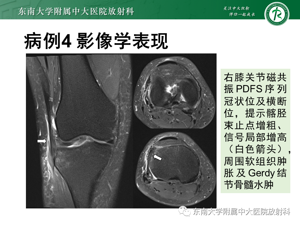 【PPT】髂胫束相关损伤-38