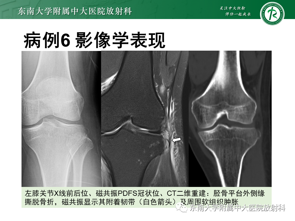 【PPT】髂胫束相关损伤-51