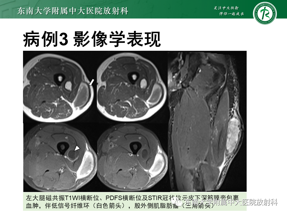 【PPT】髂胫束相关损伤-26