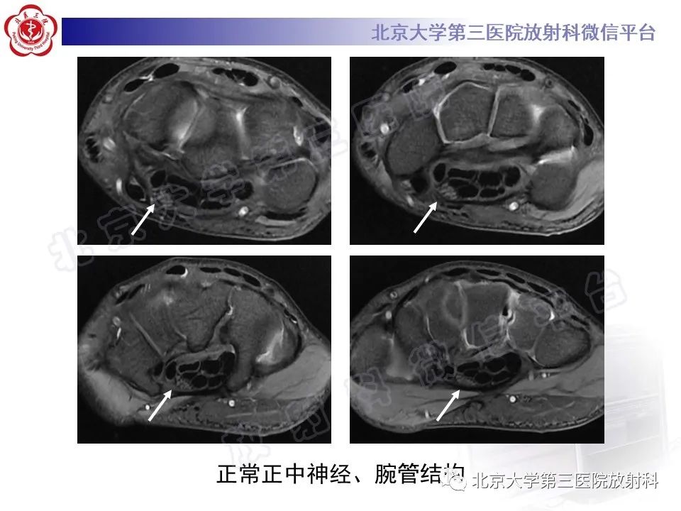 【PPT】腕管综合征-15