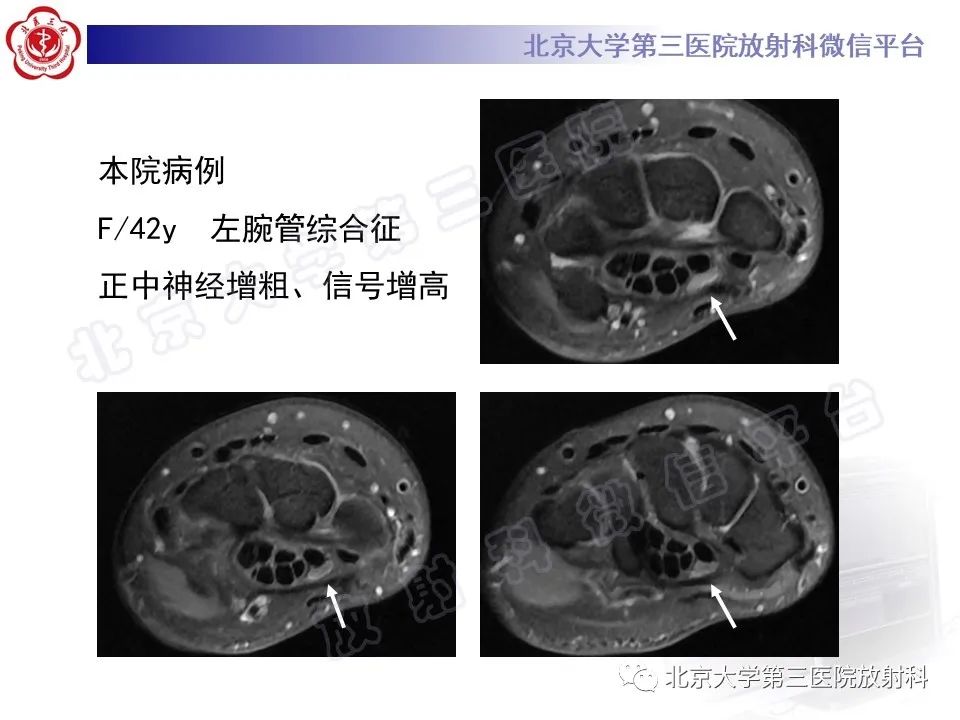 【PPT】腕管综合征-2