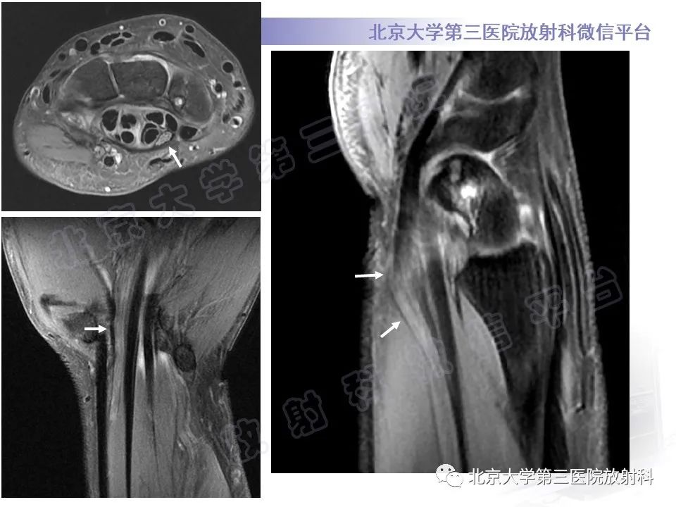 【PPT】腕管综合征-4