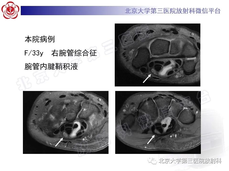 【PPT】腕管综合征-21