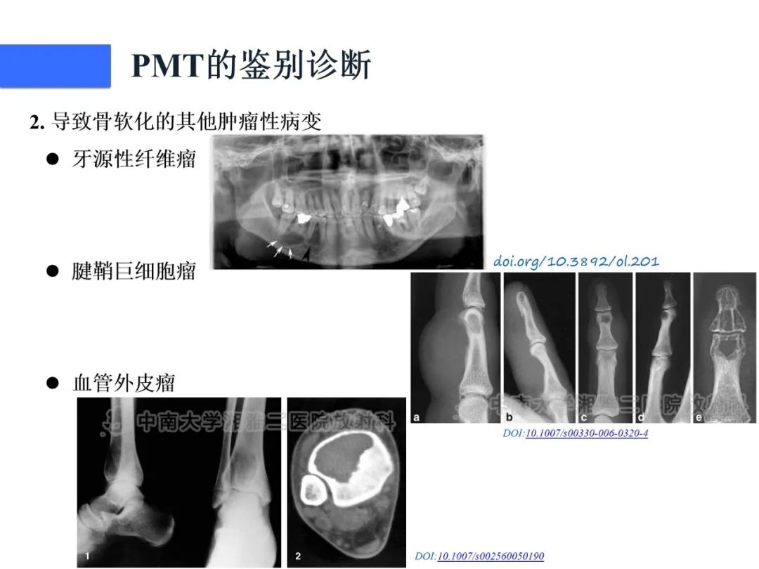 【病例】磷酸盐尿性间叶性肿瘤1例影像学诊断思路-31