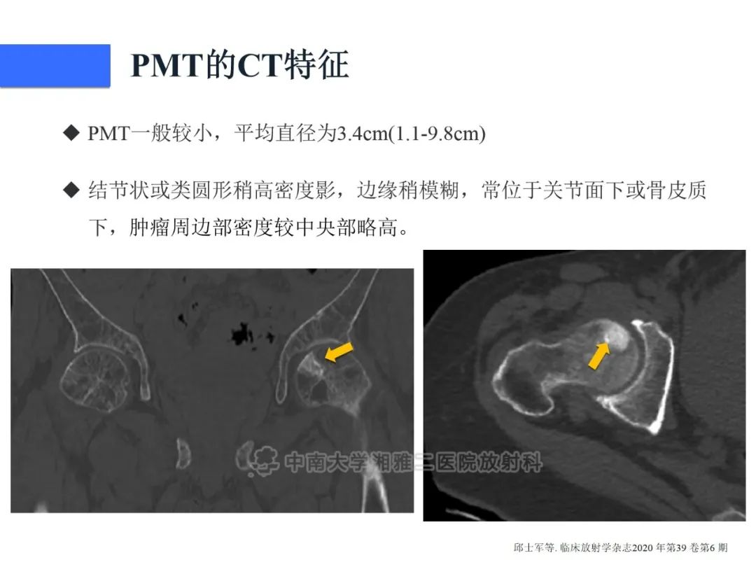【病例】磷酸盐尿性间叶性肿瘤1例影像学诊断思路-19