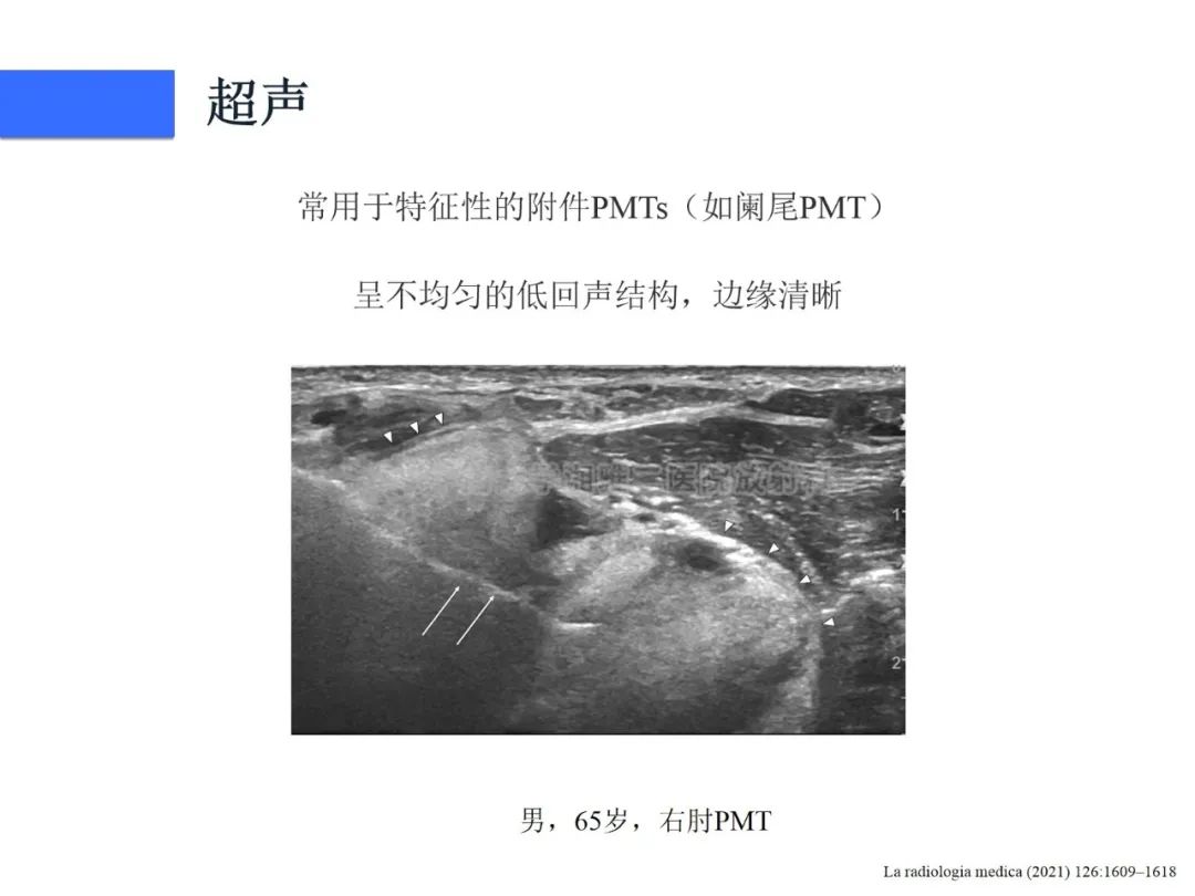 【病例】磷酸盐尿性间叶性肿瘤1例影像学诊断思路-24
