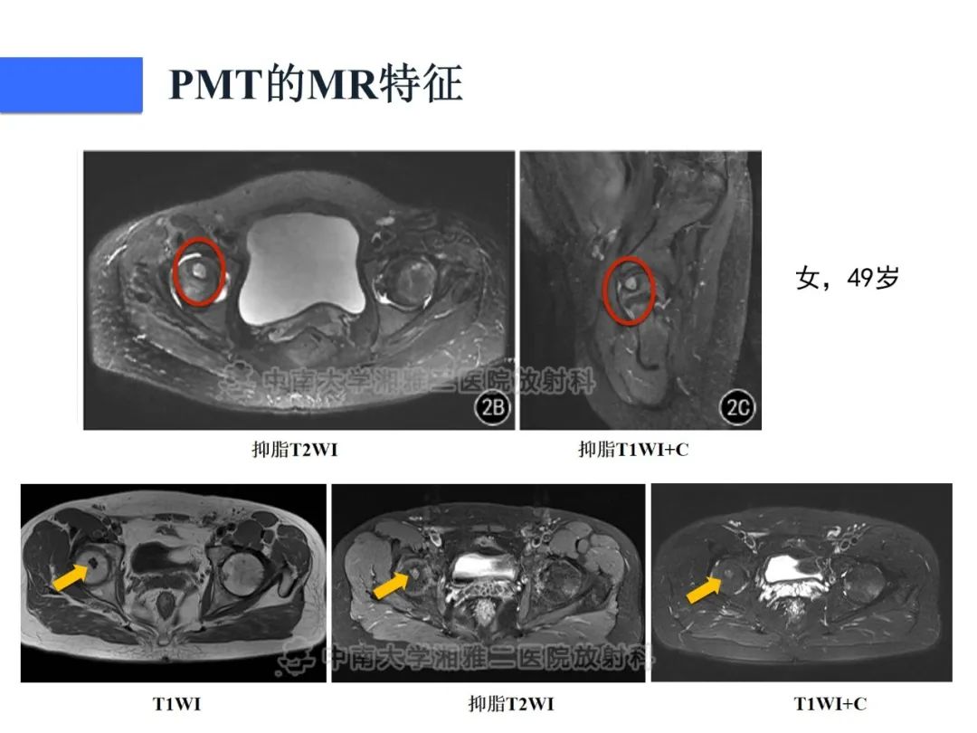 【病例】磷酸盐尿性间叶性肿瘤1例影像学诊断思路-22