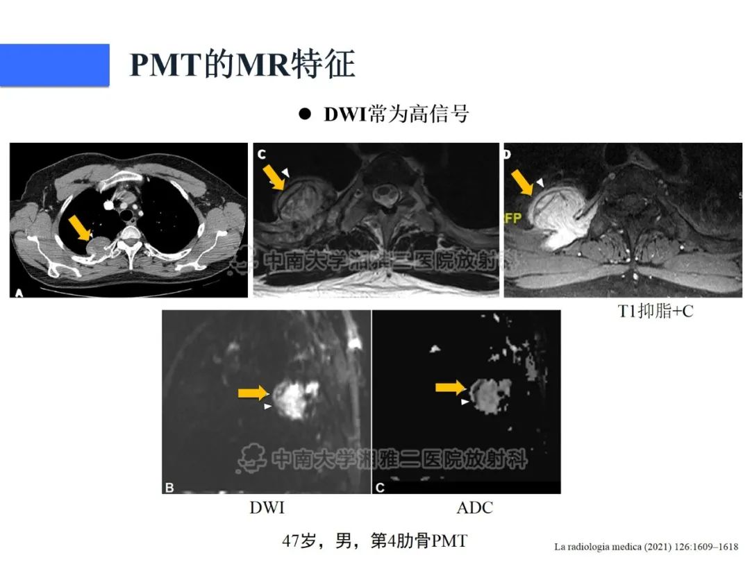 【病例】磷酸盐尿性间叶性肿瘤1例影像学诊断思路-23