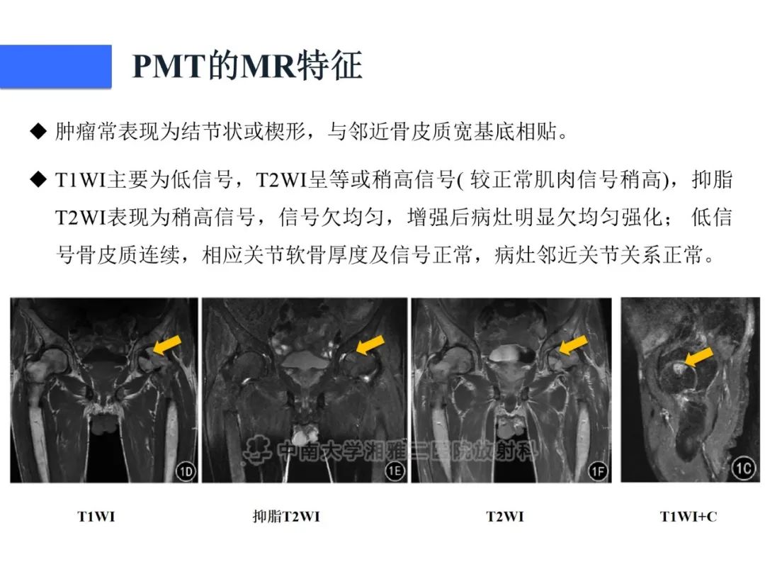 【病例】磷酸盐尿性间叶性肿瘤1例影像学诊断思路-21