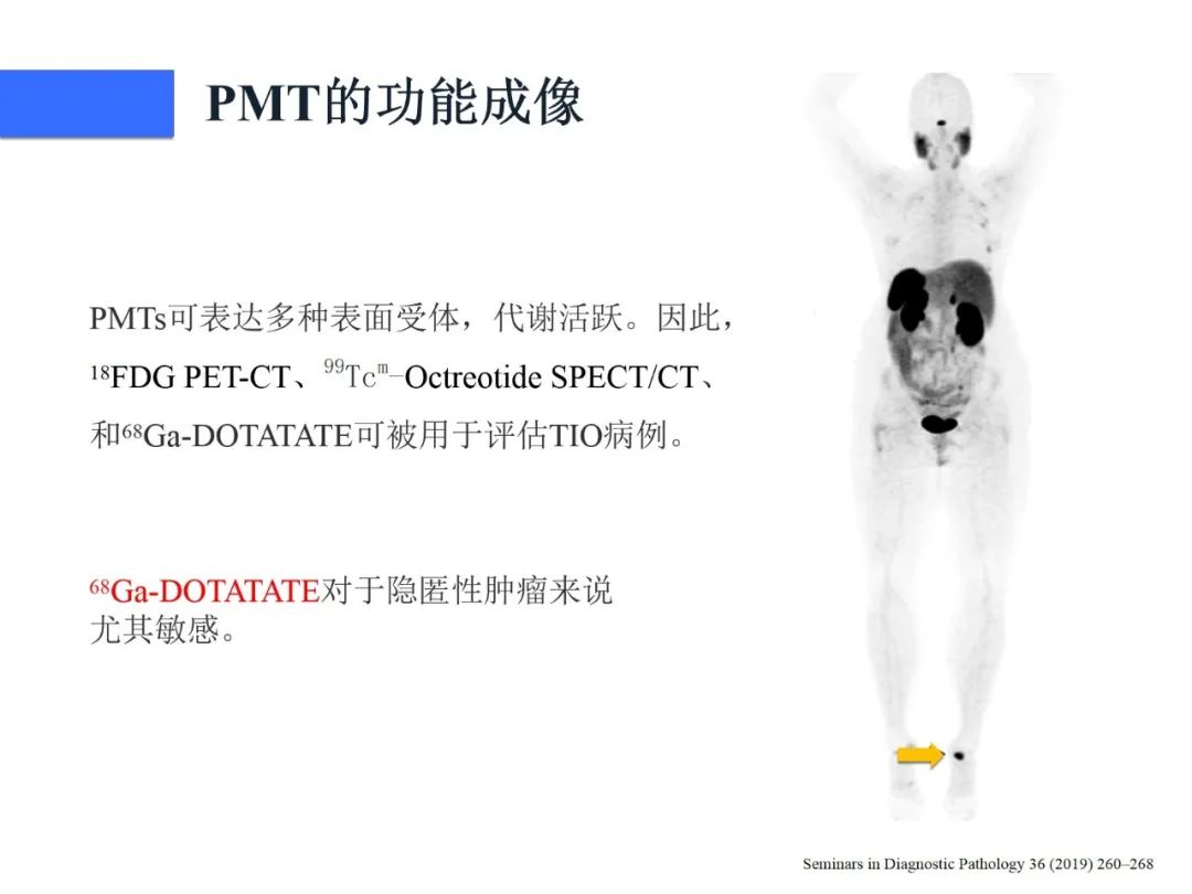 【病例】磷酸盐尿性间叶性肿瘤1例影像学诊断思路-25