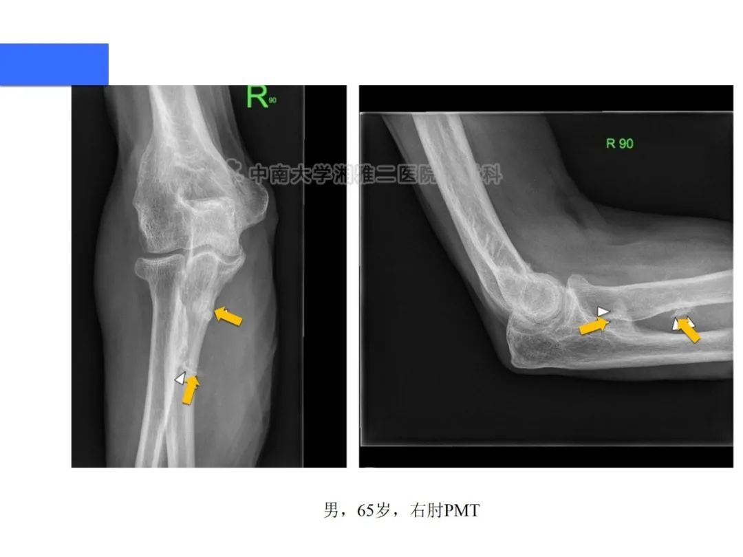 【病例】磷酸盐尿性间叶性肿瘤1例影像学诊断思路-18