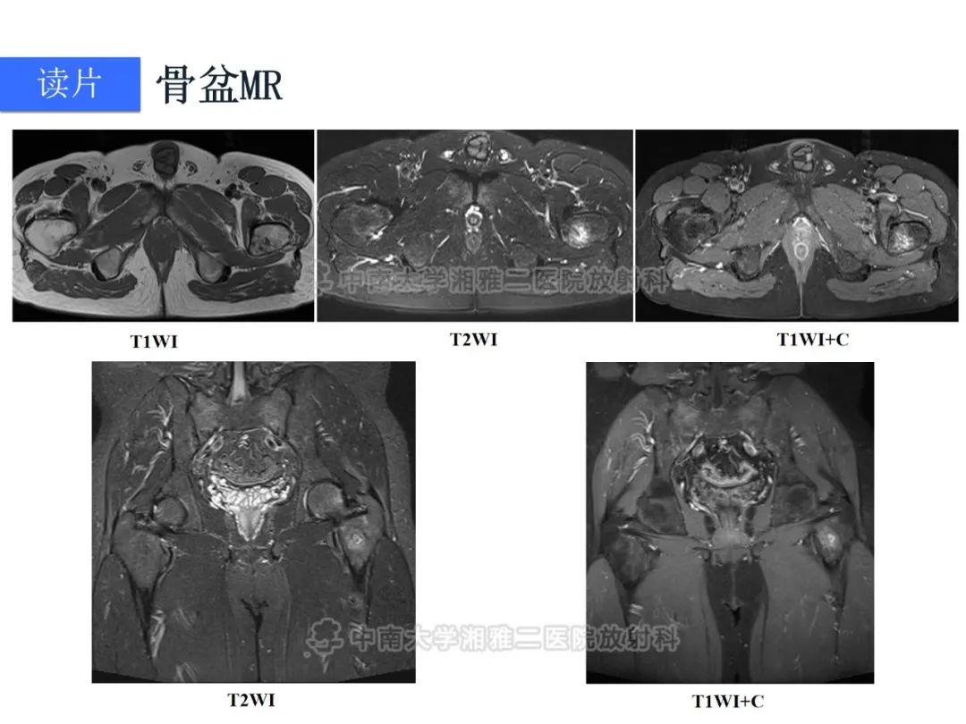 【病例】磷酸盐尿性间叶性肿瘤1例影像学诊断思路-6
