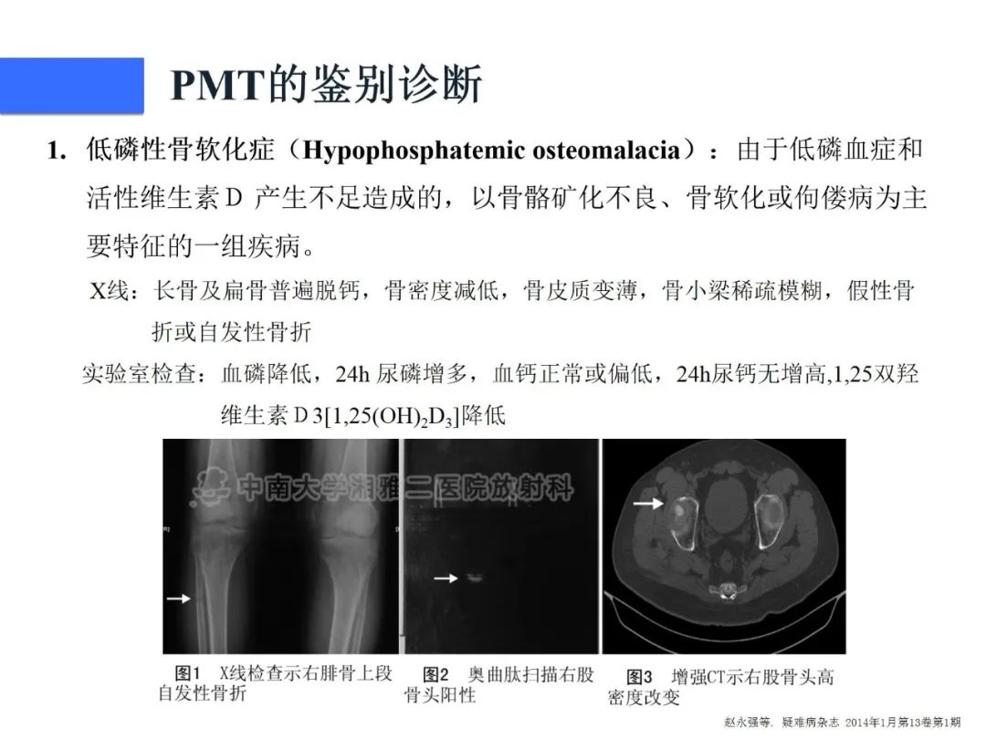 【病例】磷酸盐尿性间叶性肿瘤1例影像学诊断思路-30