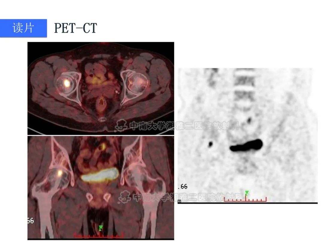 【病例】磷酸盐尿性间叶性肿瘤1例影像学诊断思路-7