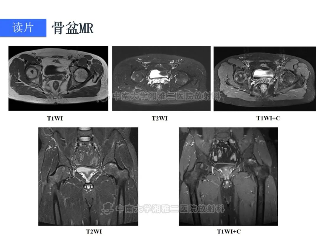 【病例】磷酸盐尿性间叶性肿瘤1例影像学诊断思路-5