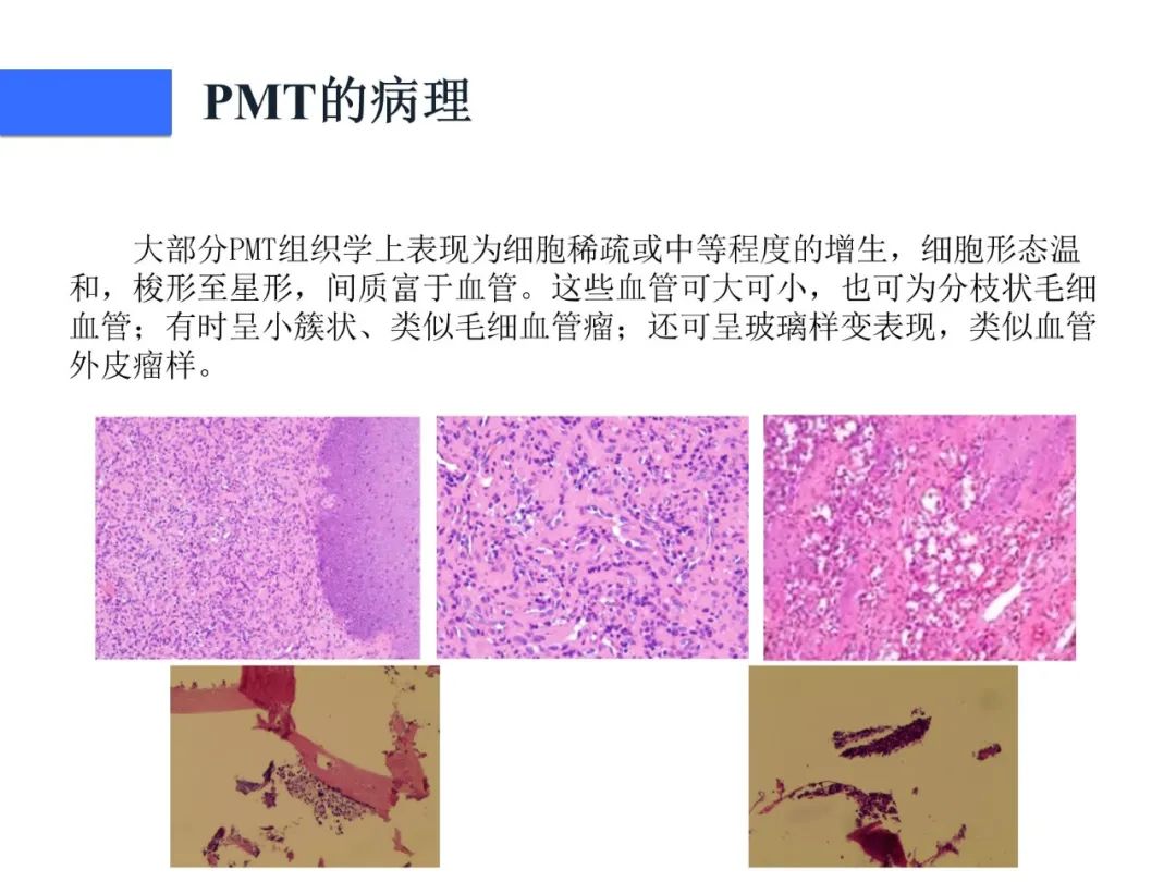 【病例】磷酸盐尿性间叶性肿瘤1例影像学诊断思路-27