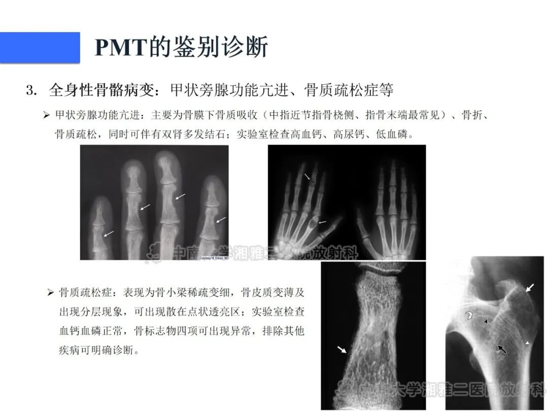 【病例】磷酸盐尿性间叶性肿瘤1例影像学诊断思路-32