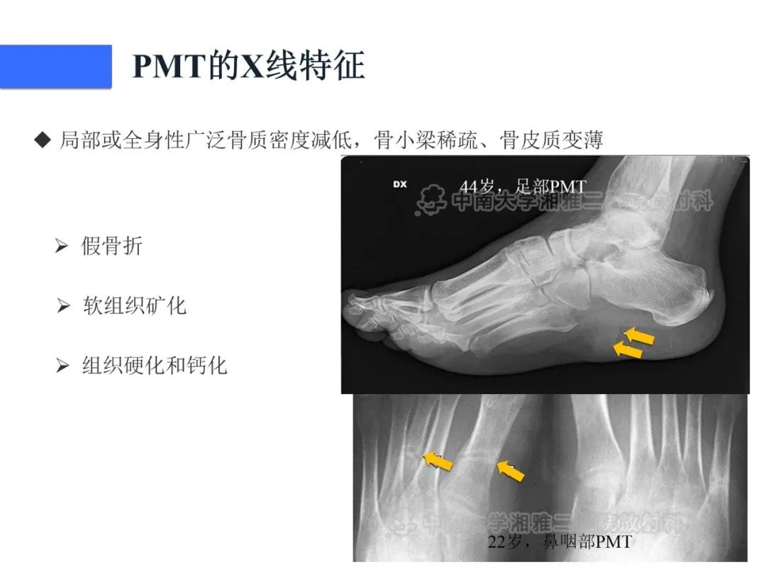 【病例】磷酸盐尿性间叶性肿瘤1例影像学诊断思路-17