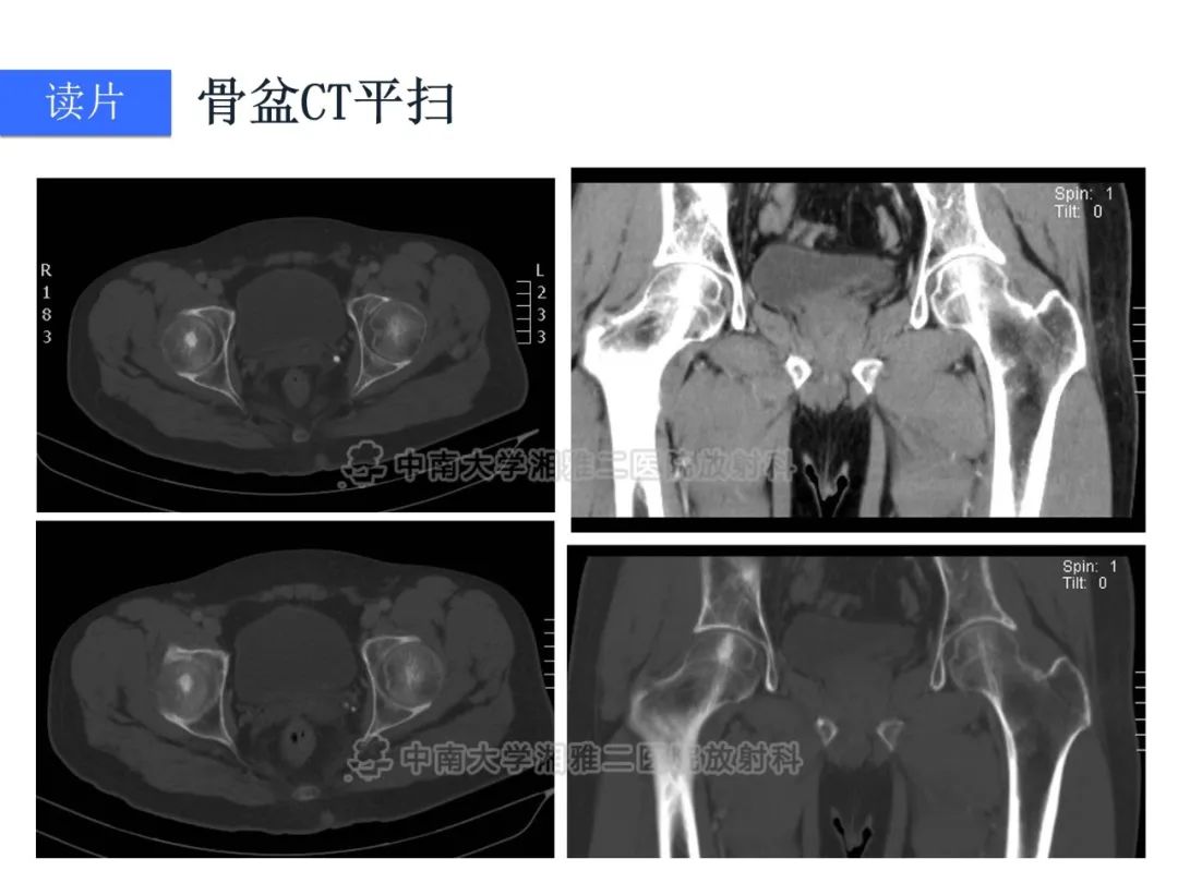 【病例】磷酸盐尿性间叶性肿瘤1例影像学诊断思路-4