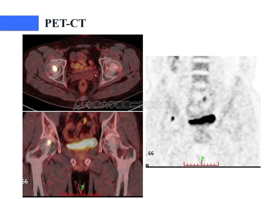 【病例】磷酸盐尿性间叶性肿瘤1例影像学诊断思路-26