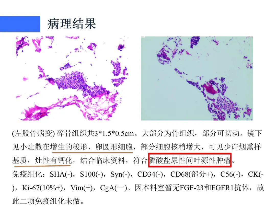 【病例】磷酸盐尿性间叶性肿瘤1例影像学诊断思路-10