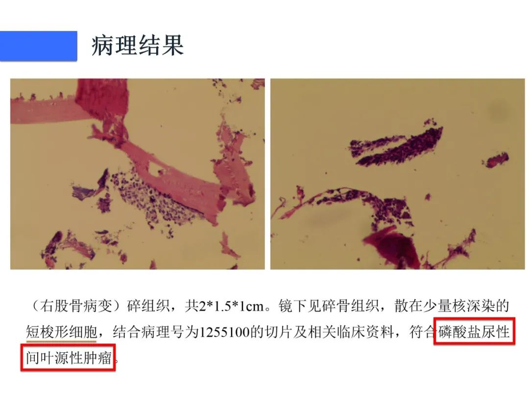 【病例】磷酸盐尿性间叶性肿瘤1例影像学诊断思路-11