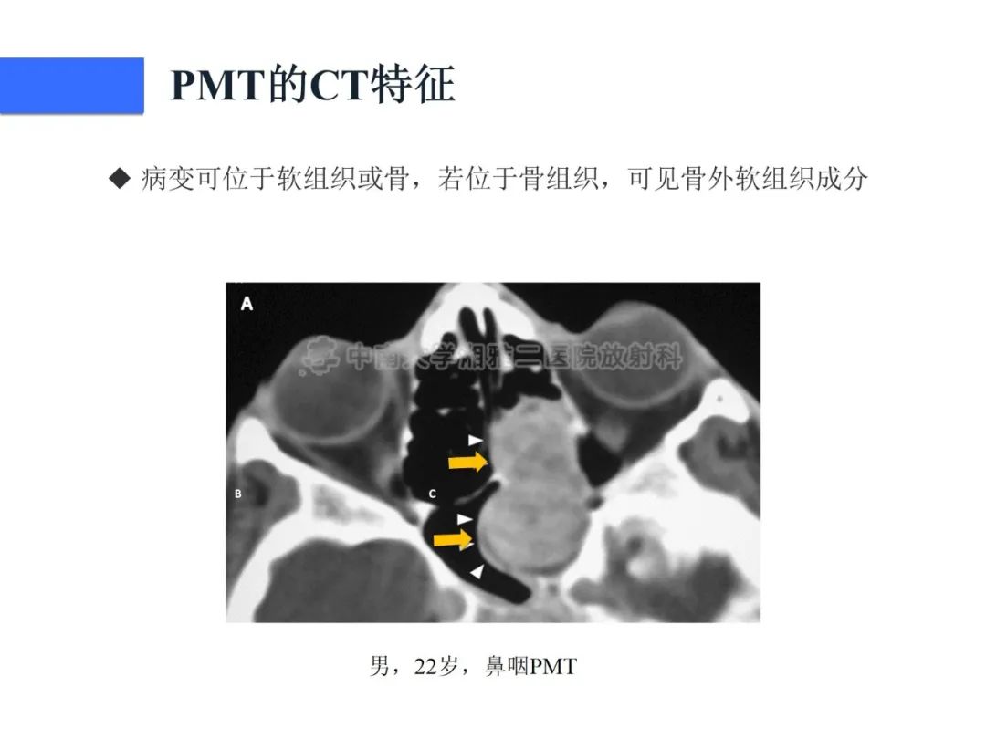 【病例】磷酸盐尿性间叶性肿瘤1例影像学诊断思路-20
