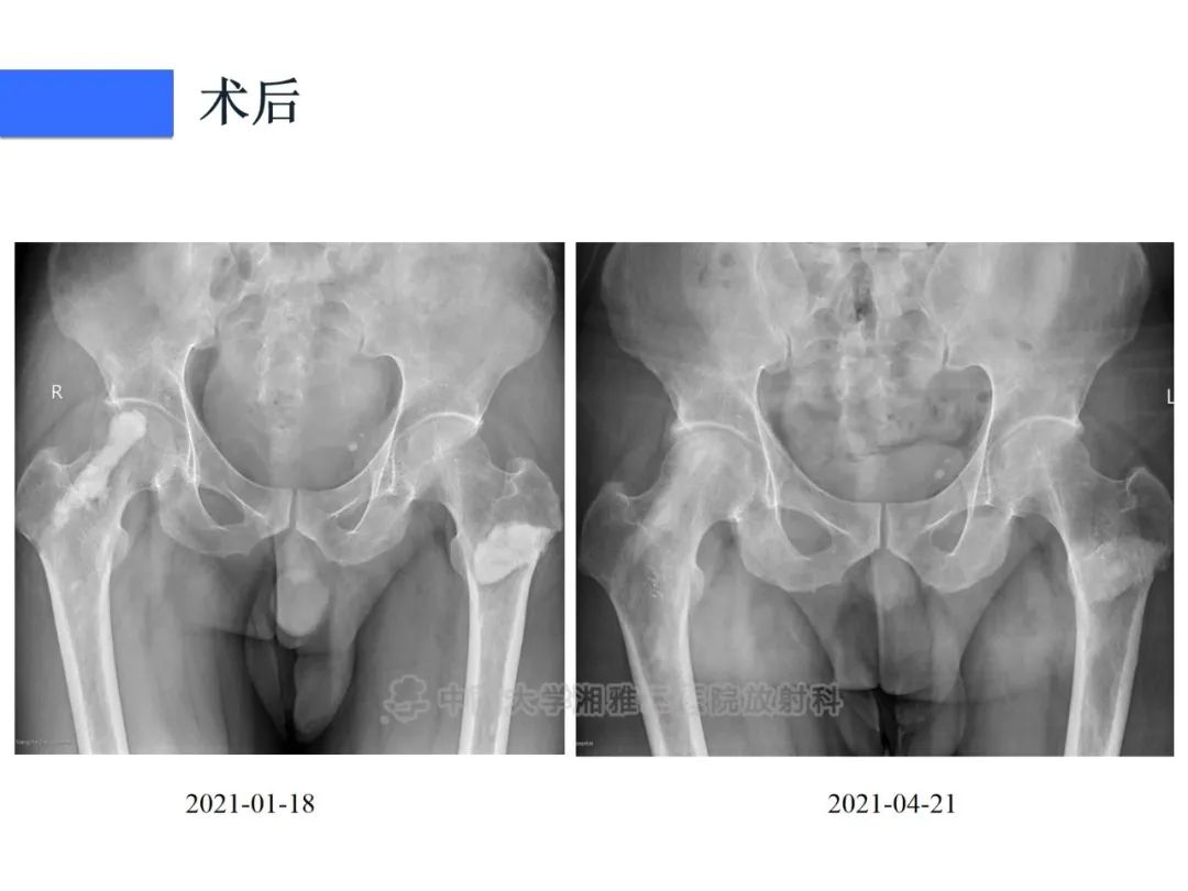 【病例】磷酸盐尿性间叶性肿瘤1例影像学诊断思路-9