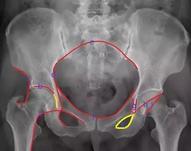 骨盆X线解剖详解-2