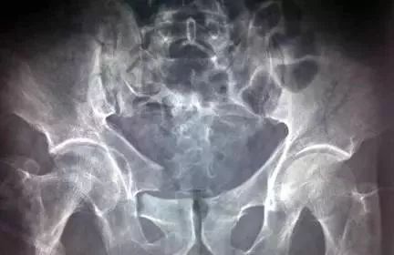 骨盆X线解剖详解-10