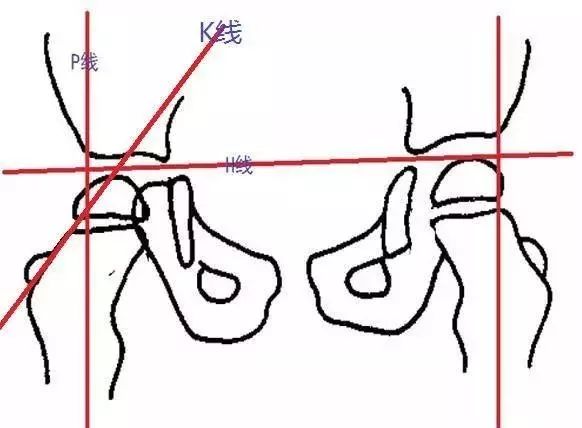 骨盆X线解剖详解-4