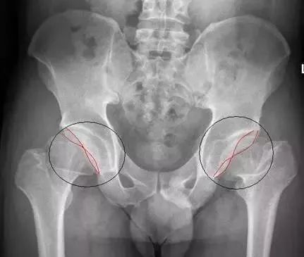 骨盆X线解剖详解-8