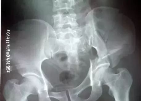 骨盆X线解剖详解-12