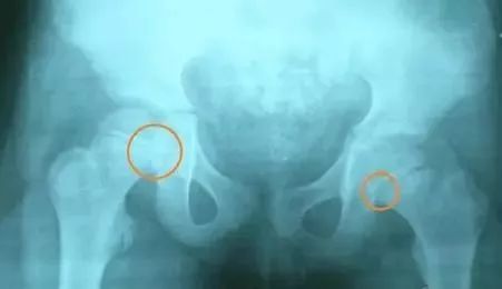 骨盆X线解剖详解-9