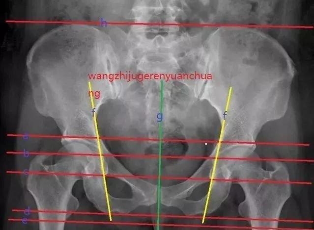 骨盆X线解剖详解-1