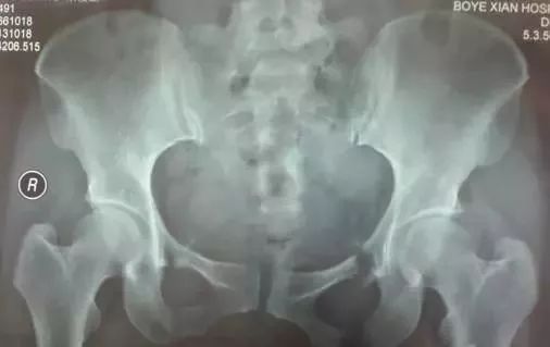 骨盆X线解剖详解-11