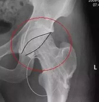 骨盆X线解剖详解-7