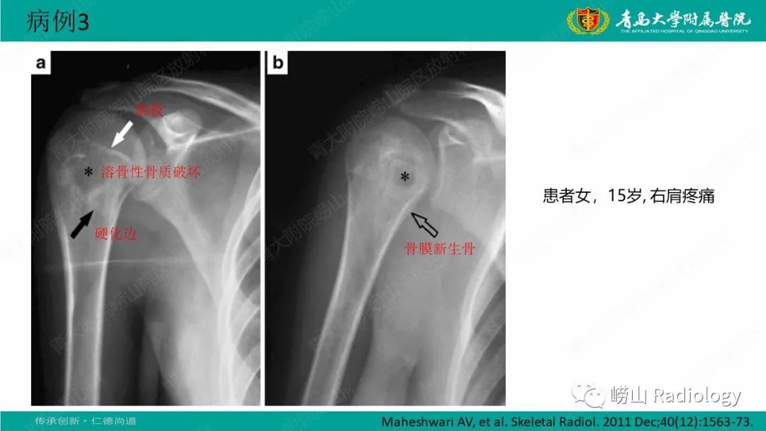 【病例】肱骨干骺端软骨母细胞瘤1例CT及MR-26